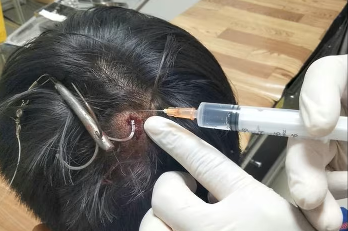 - Ảnh 1. Móc câu 3 tiêu găm vào đầu khi câu cá, thiếu niên 15 tuổi nhập viện - Ảnh 1.