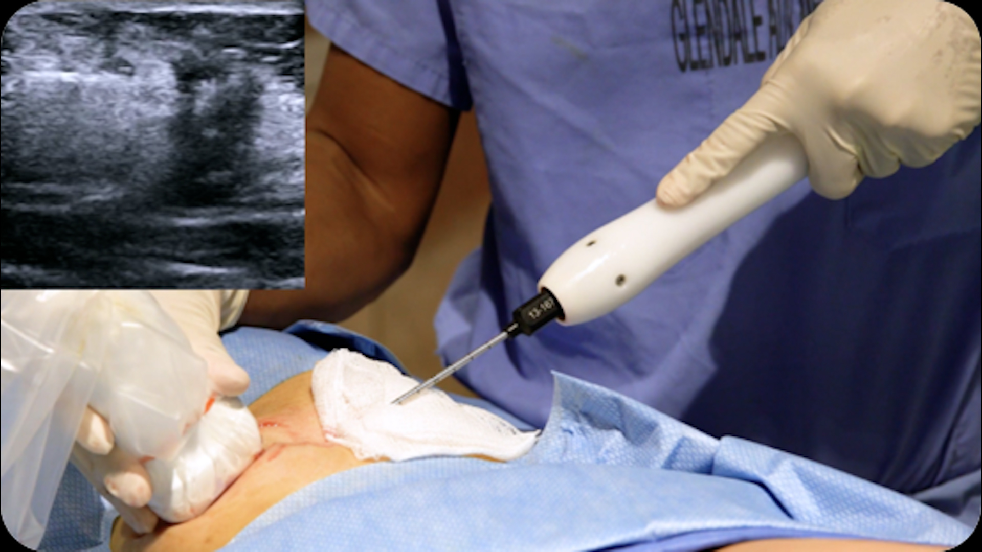 Phương ph&aacute;p đ&ocirc;ng lạnh khối u gi&uacute;p thay đổi c&aacute;ch điều trị ung thư v&uacute; - Ảnh 1.