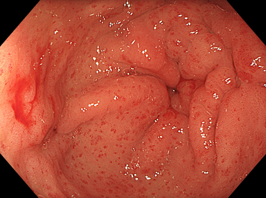 Truyền tới 23 đơn vị m&aacute;u v&igrave; hội chứng &lsquo;dạ d&agrave;y dưa hấu&rsquo; hiếm gặp - Ảnh 1.