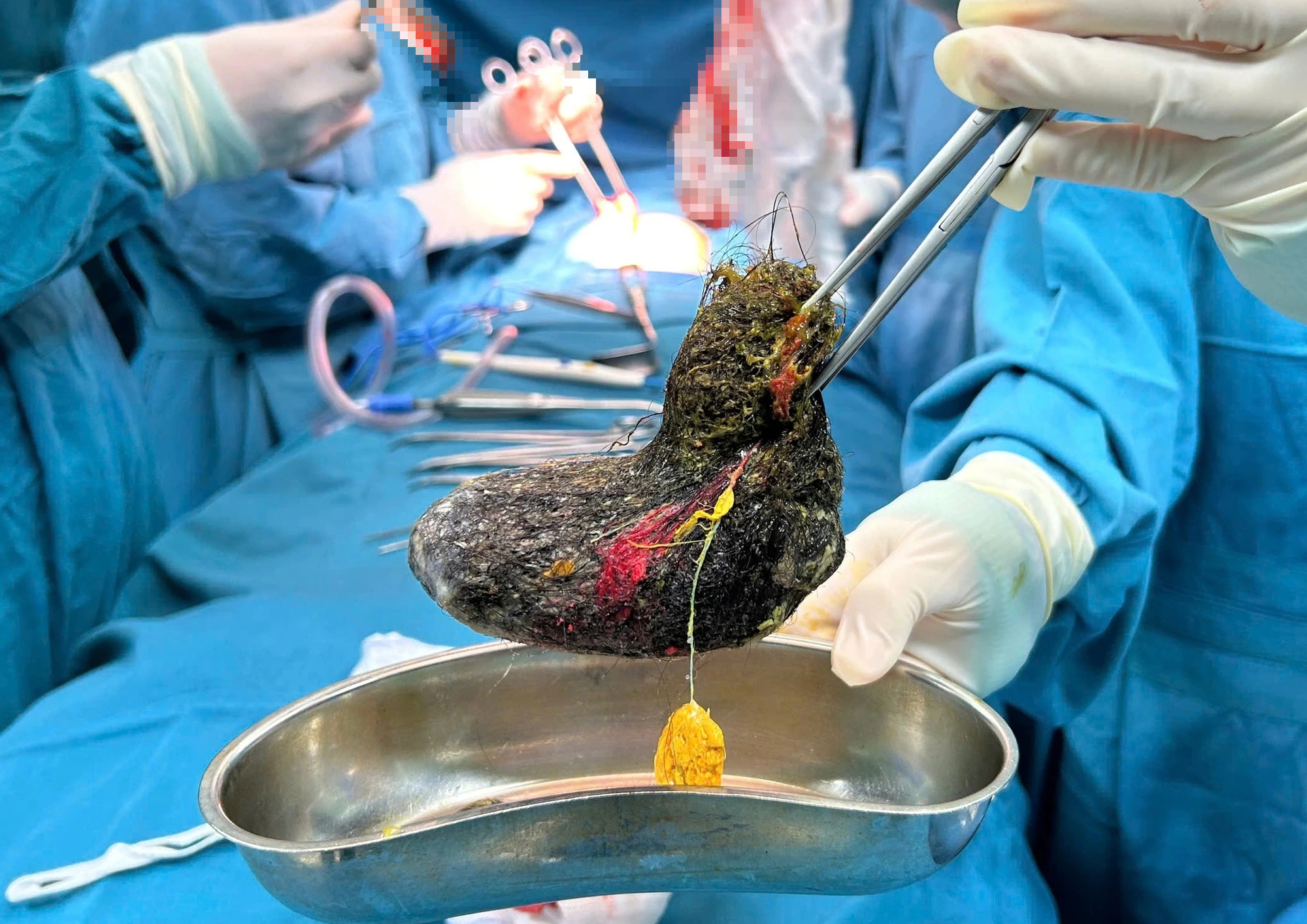 Bé gái 7 tuổi ở Quảng Ngãi mang búi tóc gần 0,5 kg trong dạ dày - Ảnh 2.