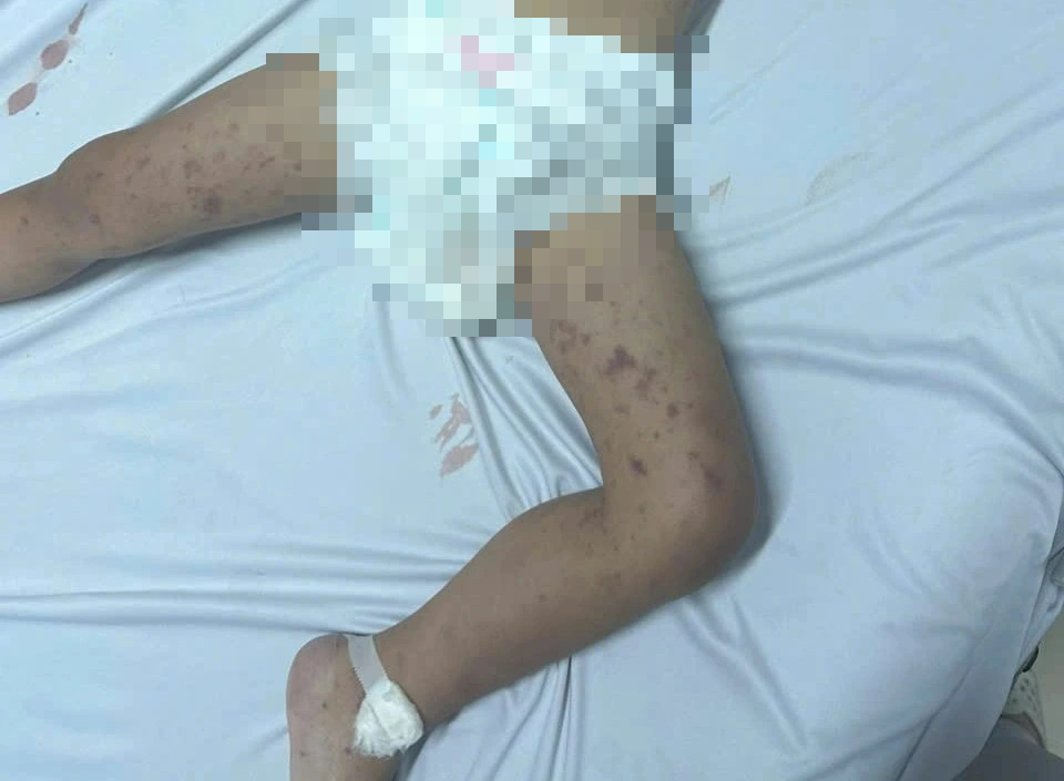 Xuất hiện viêm não mô cầu, Đắk Lắk khẩn trương truy vết người tiếp xúc- Ảnh 1.