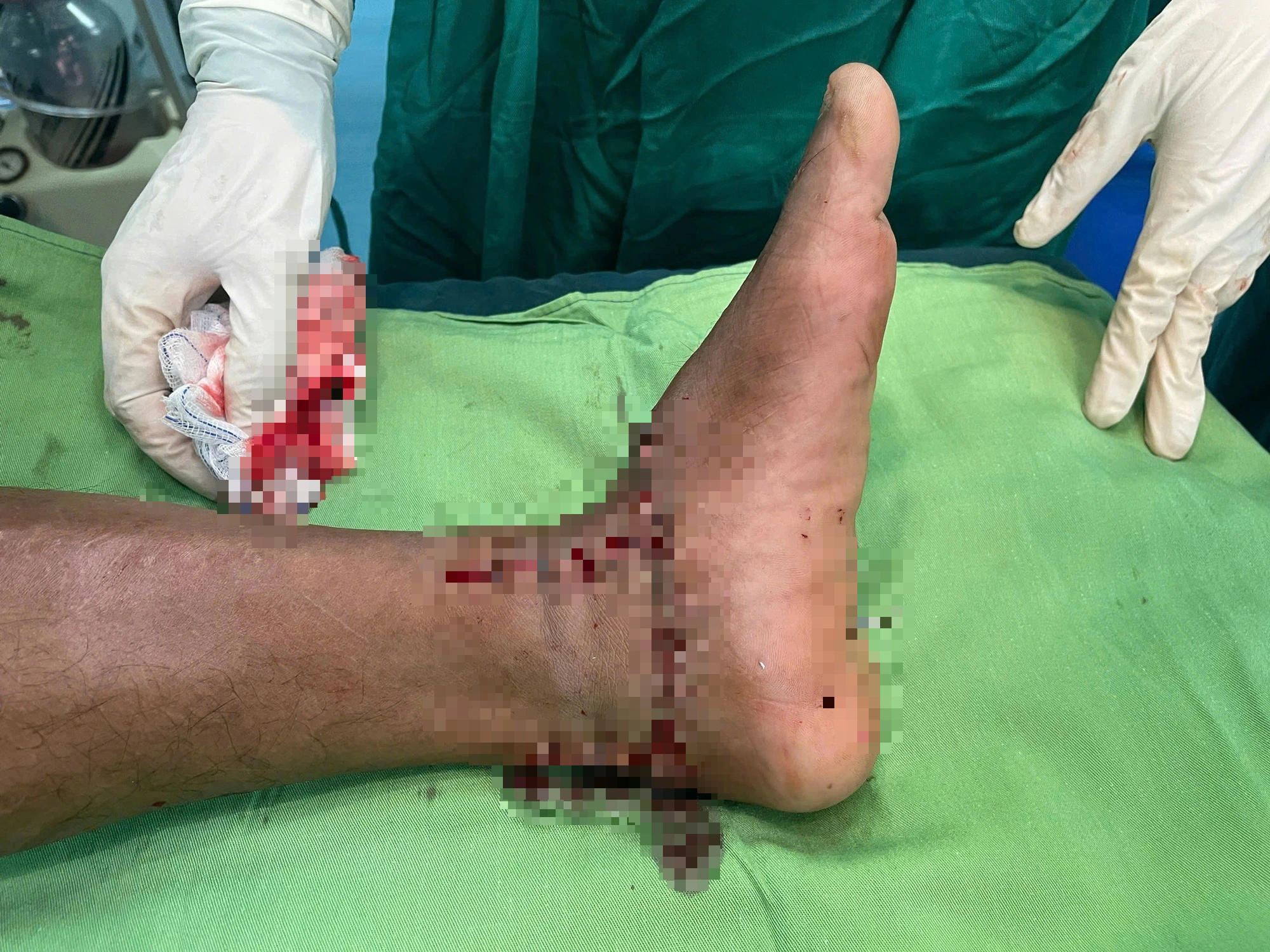 Kích hoạt báo động đỏ, cứu thành công ca đứt lìa bàn chân do máy cắt cỏ- Ảnh 2.