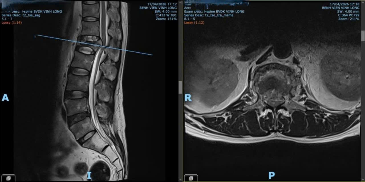 Cứu thành công trường hợp hội chứng chùm đuôi ngựa do chấn thương do ngã giàn giáo - Ảnh 2.