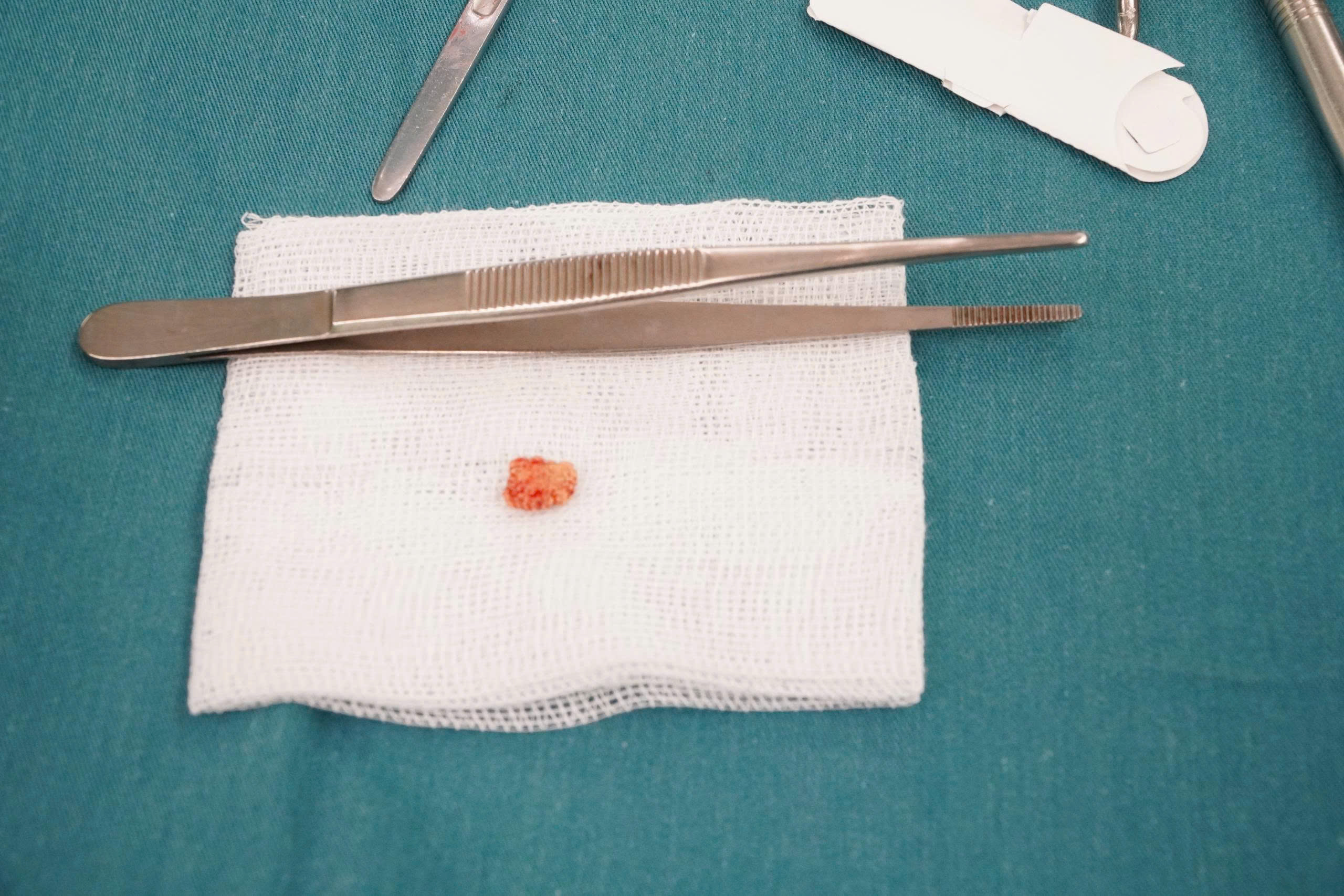 Lần đầu tiên Bệnh viện đa khoa Vũng Tàu phẫu thuật lấy sỏi tuyến dưới hàm - Ảnh 1.