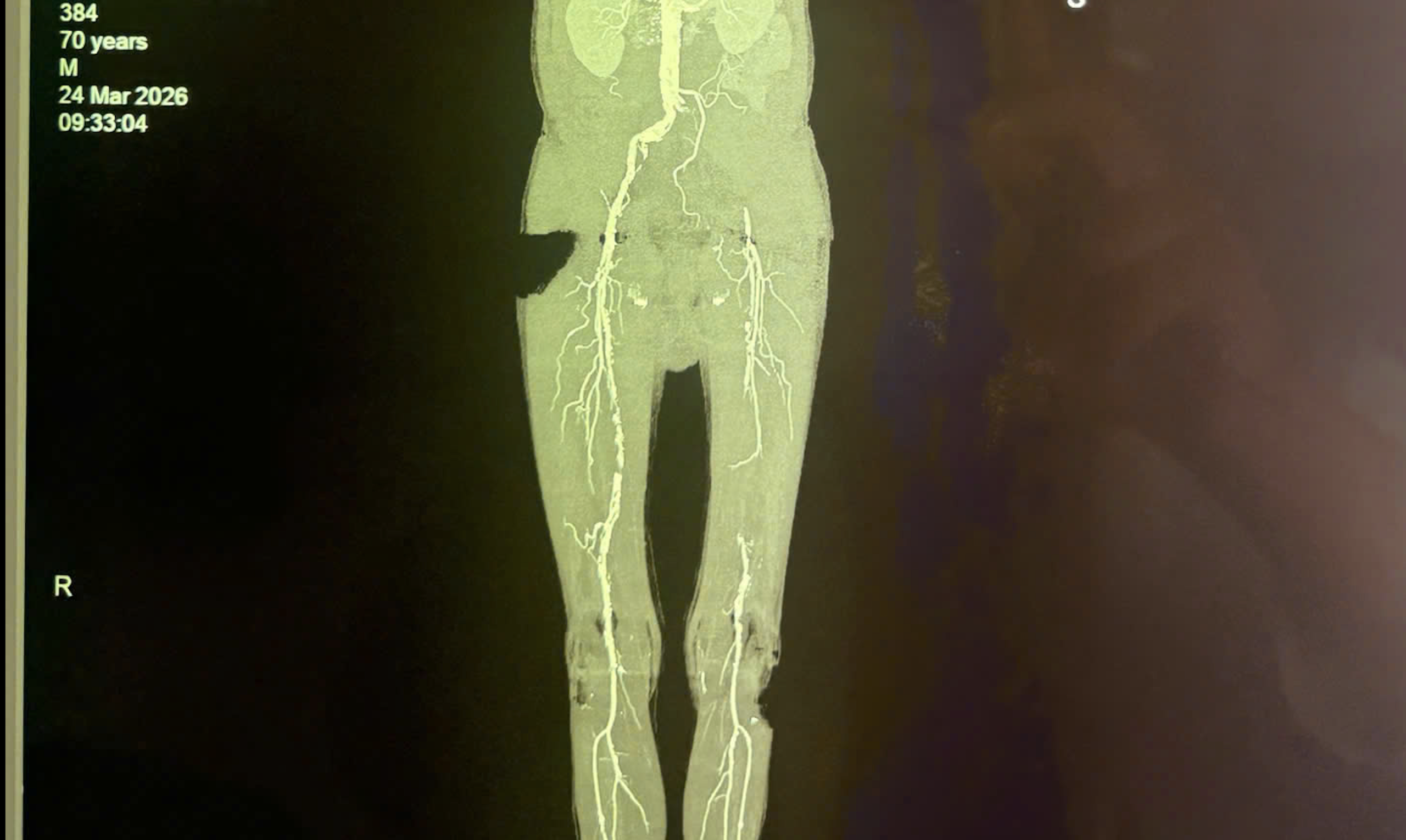 Loét gót chân và bệnh lý động mạch chi dưới: Nguy cơ họai tử Cần lưu ý - Ảnh 1. Loét gót chân kéo dài, bệnh nhân suýt phải cưa chân - Ảnh 1.