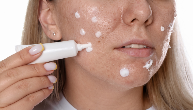 Vì sao nhiều người trị sẹo mãi không hiệu quả dù rất chăm skincare? - Ảnh 1.