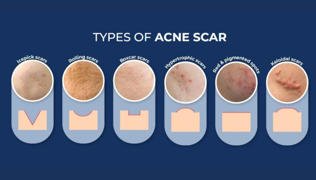 Vì sao nhiều người trị sẹo mãi không hiệu quả dù rất chăm skincare? - Ảnh 2.