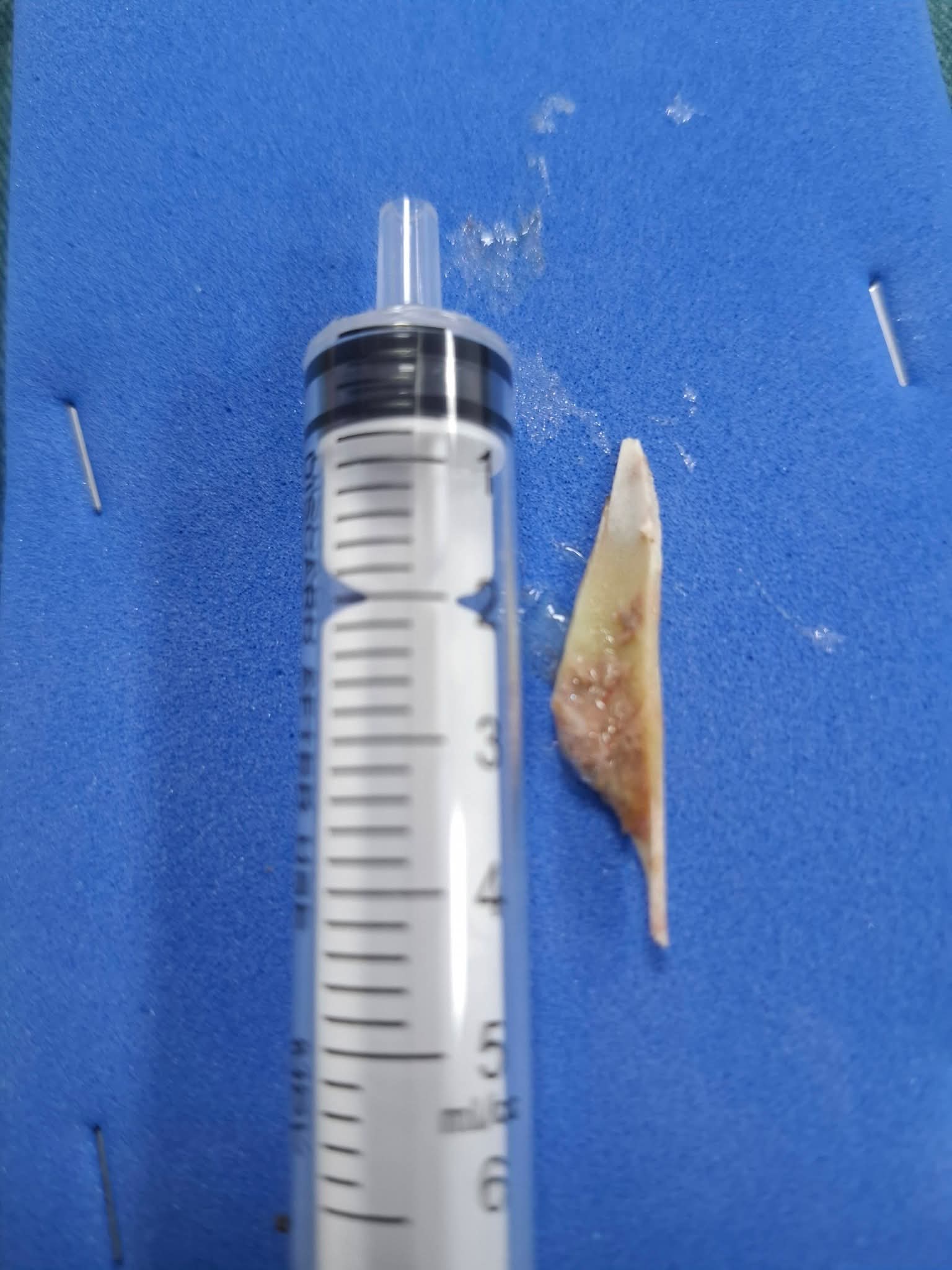 Người phụ nữ 74 tuổi bị đoạn xương dài hơn 3,5 cm sắc nhọn đâm xuyên thực quản- Ảnh 1. Người phụ nữ 74 tuổi bị đoạn xương dài hơn 3,5 cm sắc nhọn đâm xuyên thực quản- Ảnh 1.