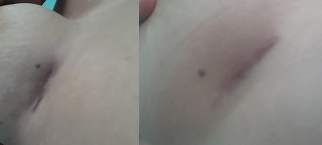 Chuyên gia phẫu thuật thẩm mỹ nói gì về hiệu quả miếng dán ép sẹo sa trễ? - Ảnh 10.