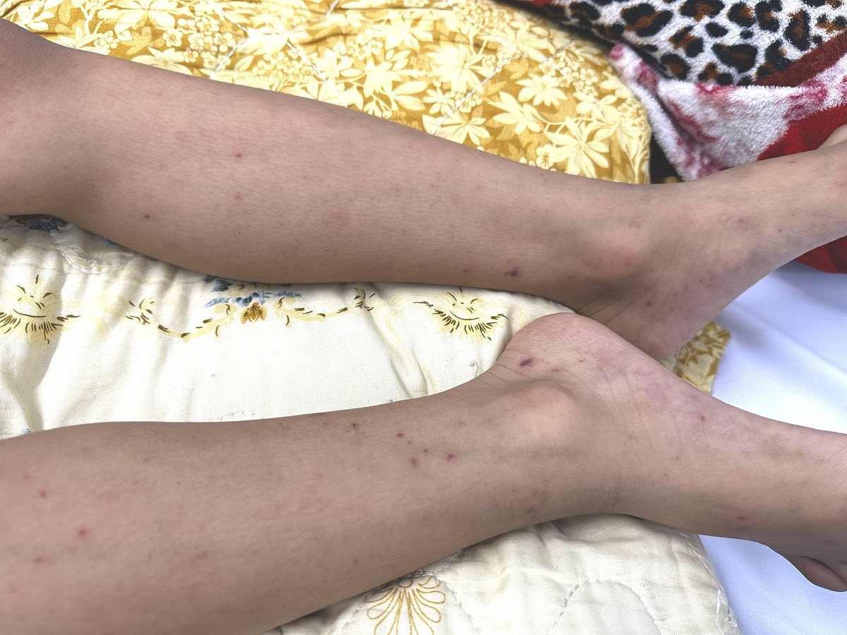 TP.HCM: Cứu sống bé trai 7 tuổi mắc não mô cầu - Ảnh 1.