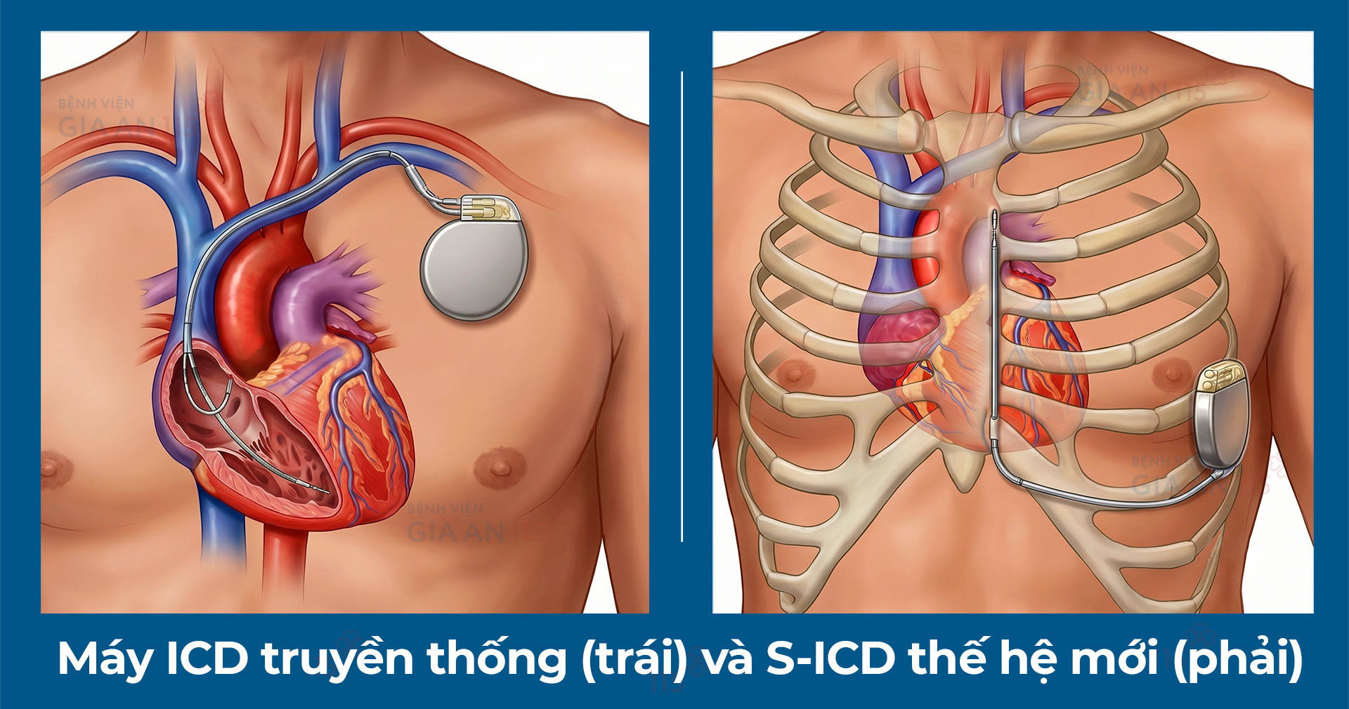 Bước tiến mới trong điều trị rối loạn nhịp tim: Lần đầu cấy máy S-ICD - Ảnh 1.