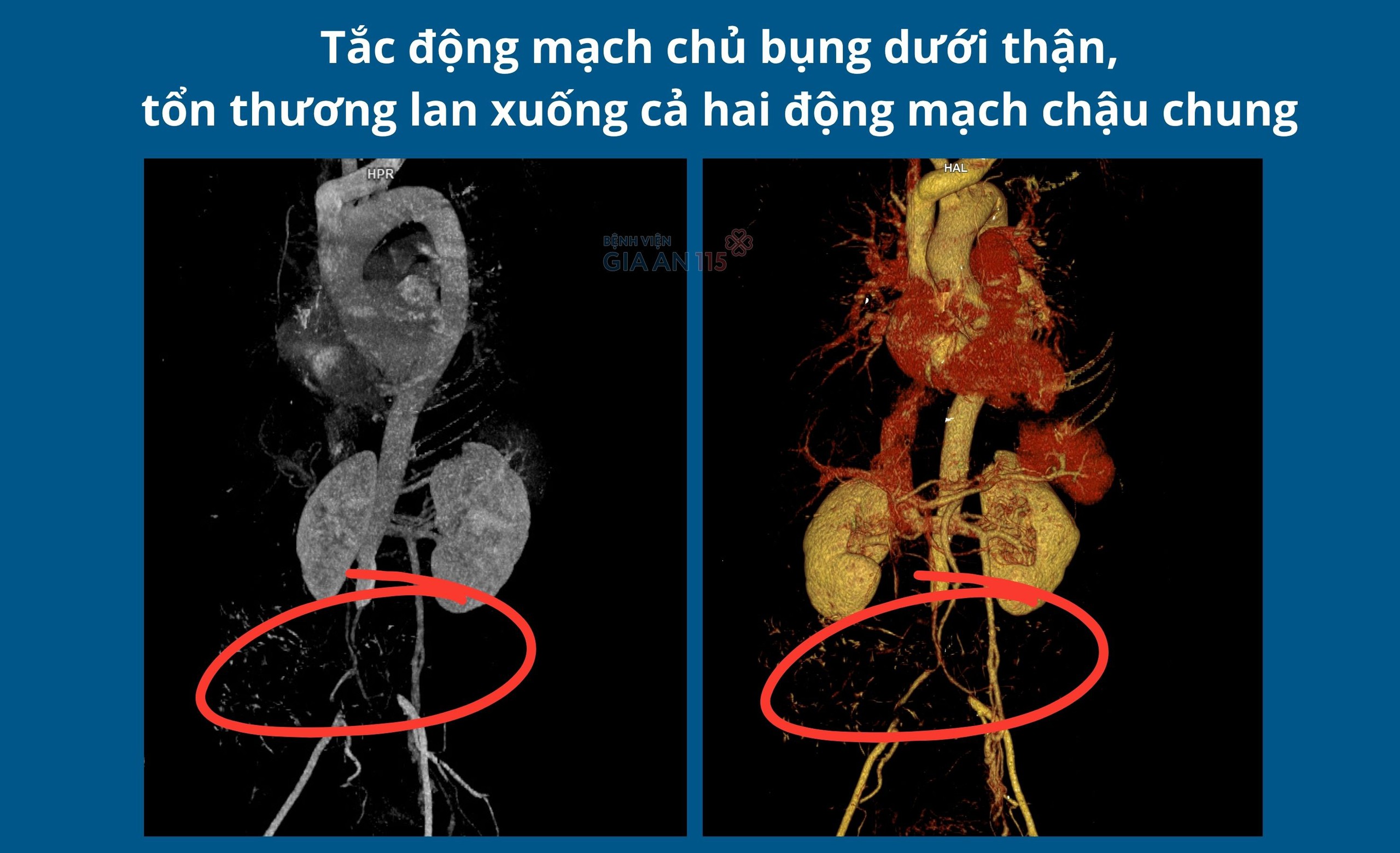 Tưởng thoái hóa khớp, người phụ nữ phát hiện động mạch chủ bụng bị tắc hoàn toàn - Ảnh 1.