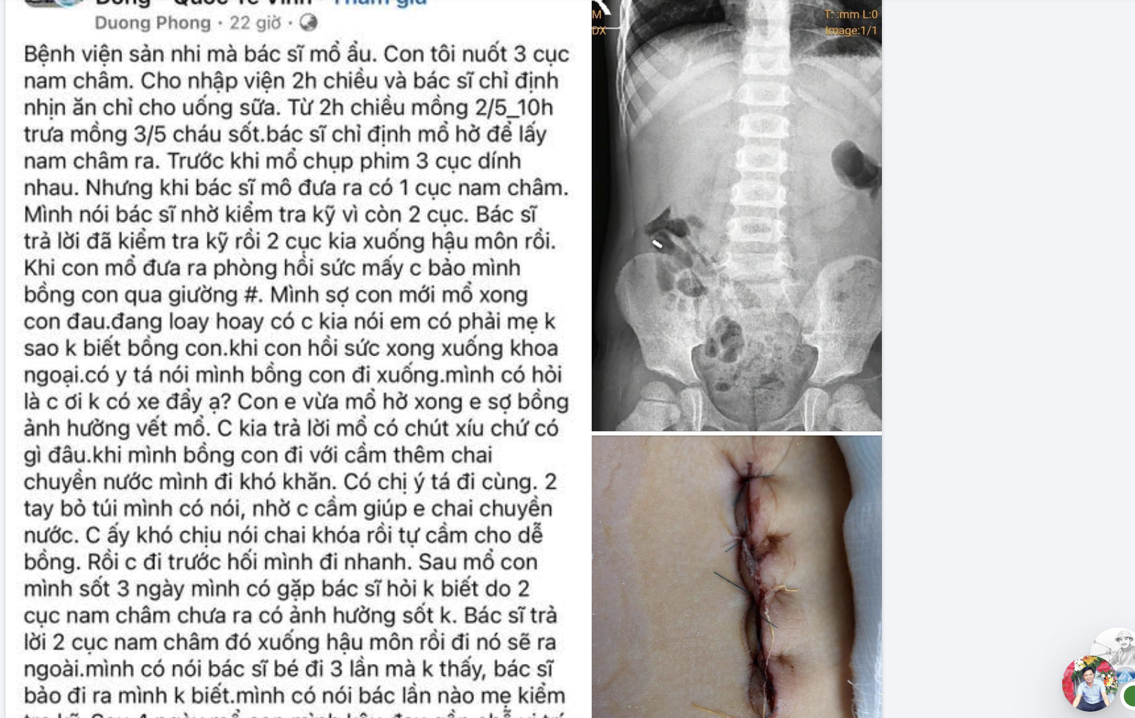 Bệnh viện lên tiếng vụ bệnh nhi bị 'bỏ sót' nam châm khi mổ gây xôn xao - Ảnh 1.