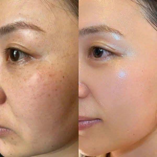 +5 serum mờ n&aacute;m hỗn hợp, kể cả n&aacute;m l&acirc;u năm cũng cải thiện nhanh ch&oacute;ng - Ảnh 1.
