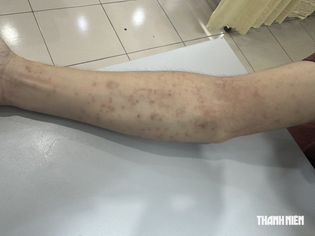 Trị tận gốc viêm da mùa nắng nóng - Ảnh 1.