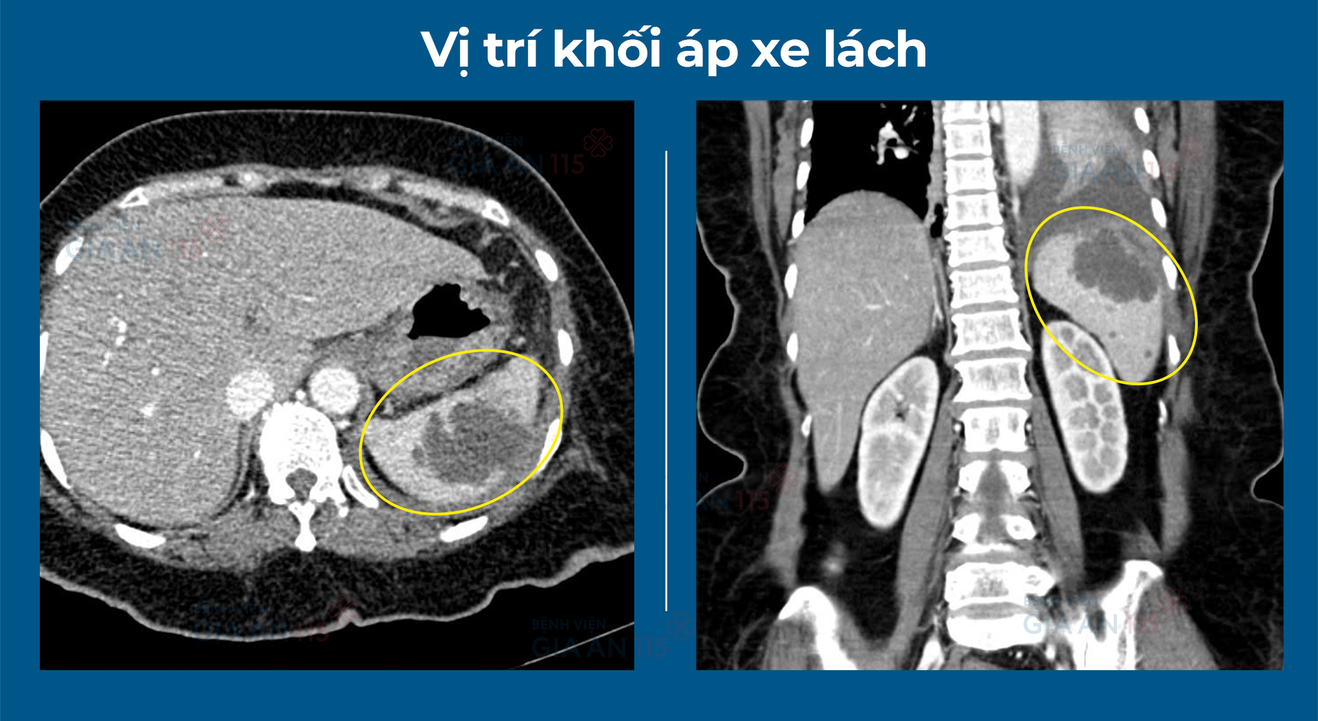 Sốt kéo dài, đau bụng âm ỉ: Người phụ nữ nguy kịch vì áp xe lách vỡ - Ảnh 1.