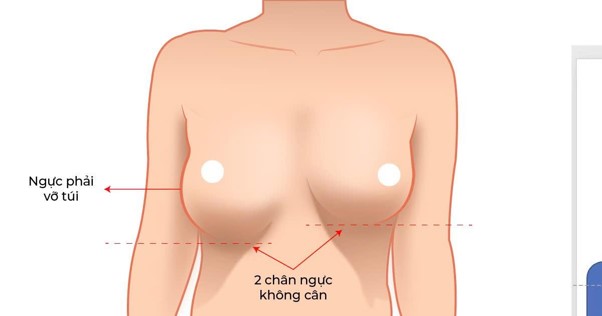 Kỹ thuật tạo khoang tăng tuổi thọ của t&uacute;i ngực  - Ảnh 1.