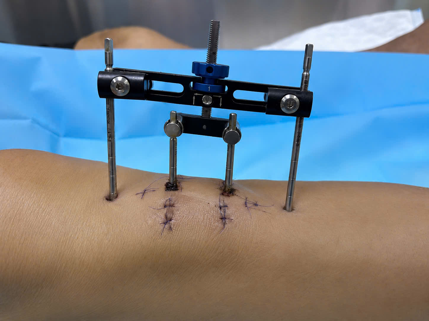 Phương pháp mới giúp bệnh nhân tiểu đường thoát nguy cơ đoạn chi tại FV - Ảnh 2.