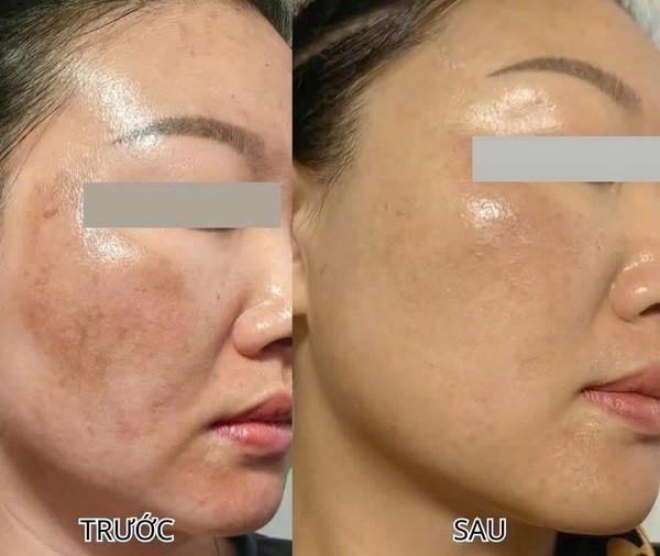 +5 serum mờ nám mảng loang lổ khắp mặt cũng cải thiện, da bật tone trắng hồng- Ảnh 1.