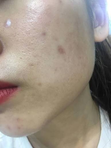 Sẹo thủy đậu c&oacute; tự hết kh&ocirc;ng? C&aacute;ch mờ sẹo sau 4 tuần, kể cả l&acirc;u năm - Ảnh 4.