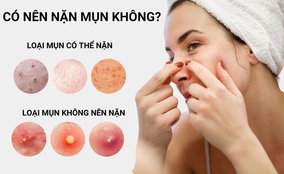 Có nên nặn mụn? Chia sẻ từ chuyên gia khiến nhiều người tiếc vì không biết sớm- Ảnh 1.
