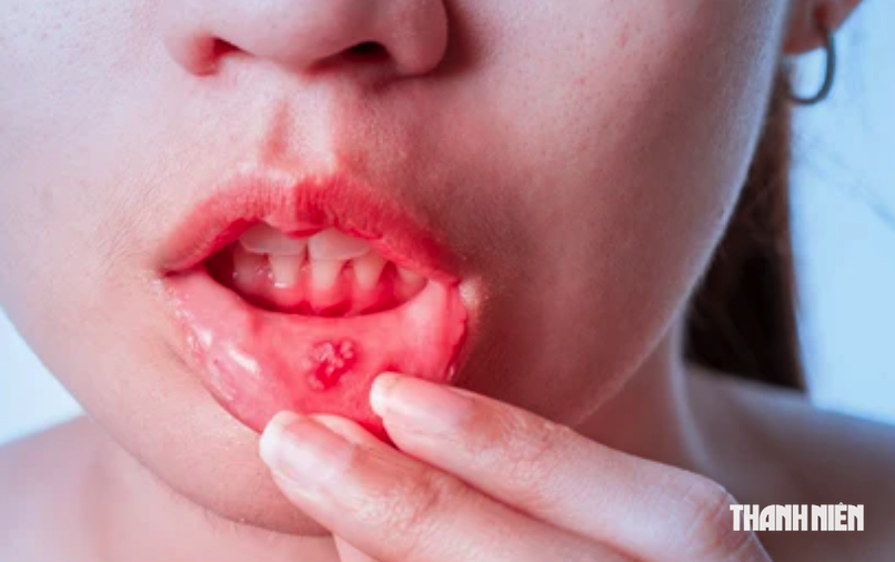 B&aacute;c sĩ ơi: Dấu hiệu n&agrave;o cảnh b&aacute;o ung thư khoang miệng? - Ảnh 1.