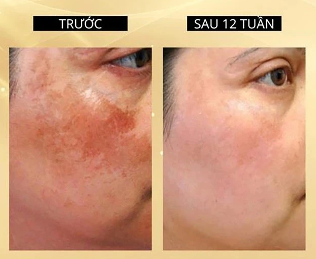 +7 kem mờ nám giúp da sau sinh vẫn trắng hồng rạng rỡ, mẹ tự tin hơn- Ảnh 1.