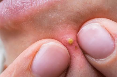 Chăm da mụn kh&ocirc;ng kết th&uacute;c khi mụn hết - Ảnh 2.
