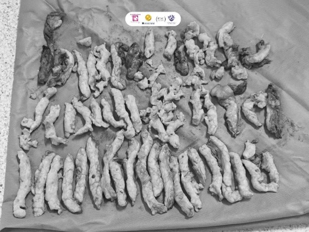 TP.HCM: Tưởng mắc bệnh tiết niệu, người phụ nữ phát hiện u xơ tử cung lớn- Ảnh 1.