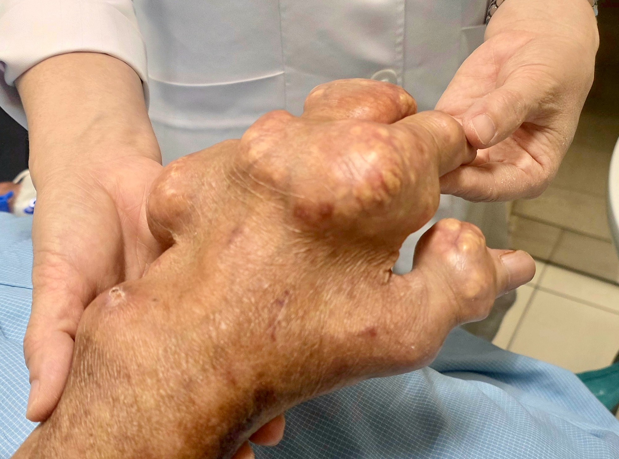 Các thực phẩm giúp kiểm soát axít uric ở người bệnh gout- Ảnh 1.
