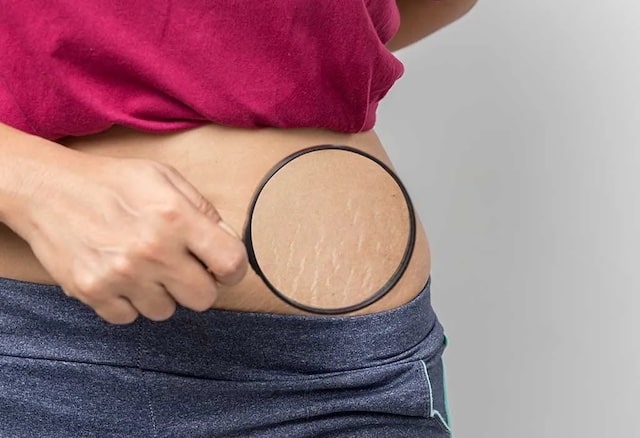 Rạn da liệu có phải là điều đáng sợ như chị em vẫn nghĩ? - Ảnh 3.