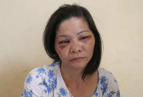 Côn trùng gây ngứa là kiến 3 khoang