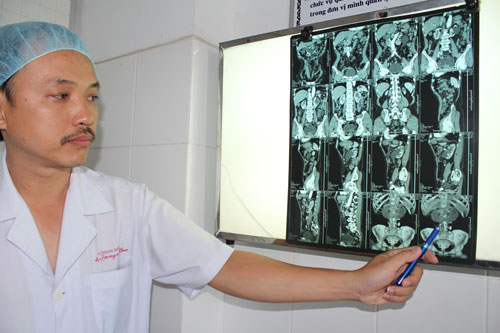 Hình ảnh hai trái thận dính vào nhau thể hiện qua phim CT Scanner