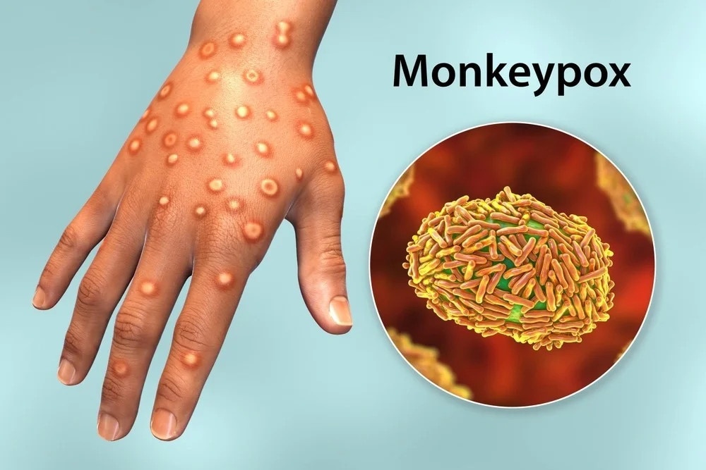 Nguy cơ mắc bệnh đậu mùa khỉ: Hình ảnh về nguy cơ lây nhiễm bệnh đậu mùa khỉ sẽ giúp bạn nhận ra các dấu hiệu cần phải đề phòng. Nắm rõ thông tin về cách phòng tránh sẽ giúp bạn tránh được bệnh lý này trong tình hình dịch bệnh đang hoành hành náo nhiệt.