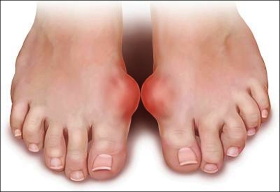 Hãy nghĩ tới bệnh gout khi ngón chân cái bị sưng, đau - Ảnh: Shutterstock 