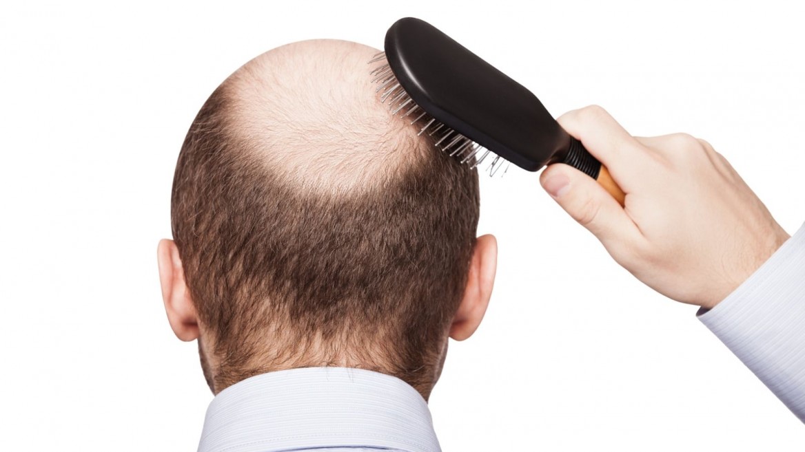 Tốp 10 nguyên nhân gây rụng tóc  cách xử lý hiệu quả nhất