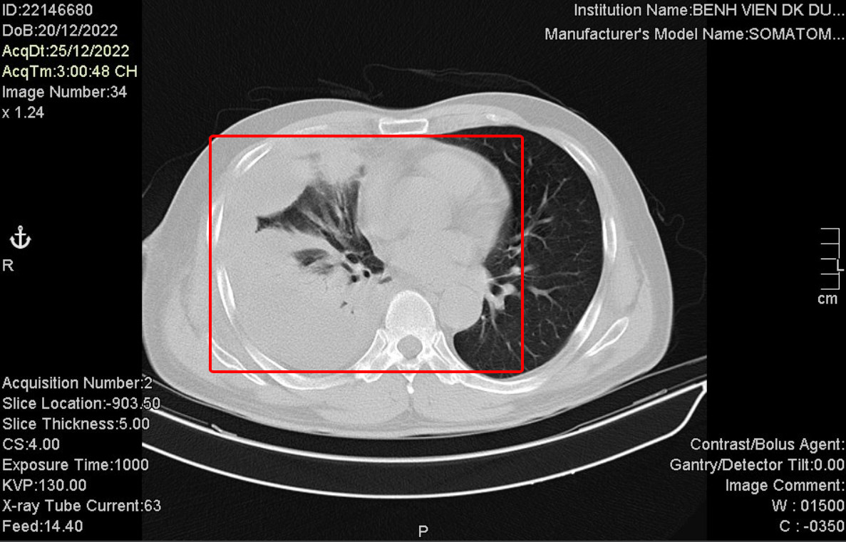 Ghi nhận các ca bệnh có ổ cặn màng phổi sau mắc Covid-19