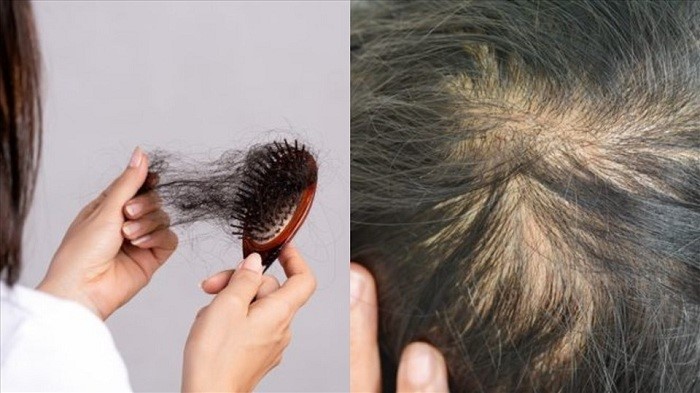 Mách bạn cách chữa trị bị rụng tóc nhiều ở nam  Be Nature Cosmetic