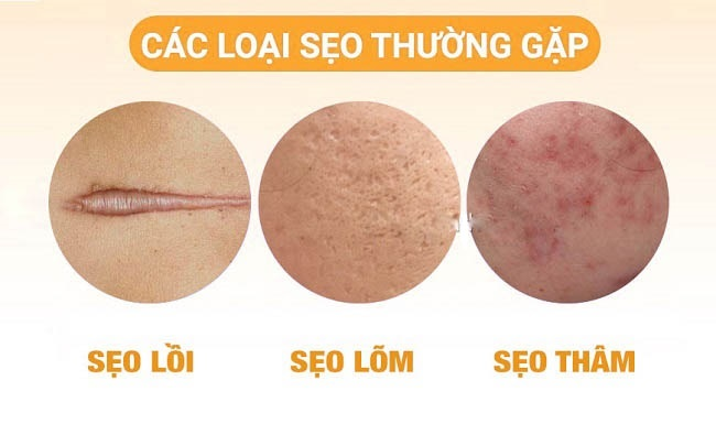 Tại sao dùng kem trị sẹo nhưng không hết sẹo?