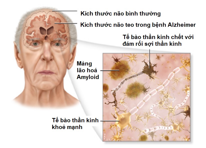 Hãy Nhận Biết Sớm để điều Trị Hiệu Quả Bệnh Mất Trí Nhớ Alzheimer