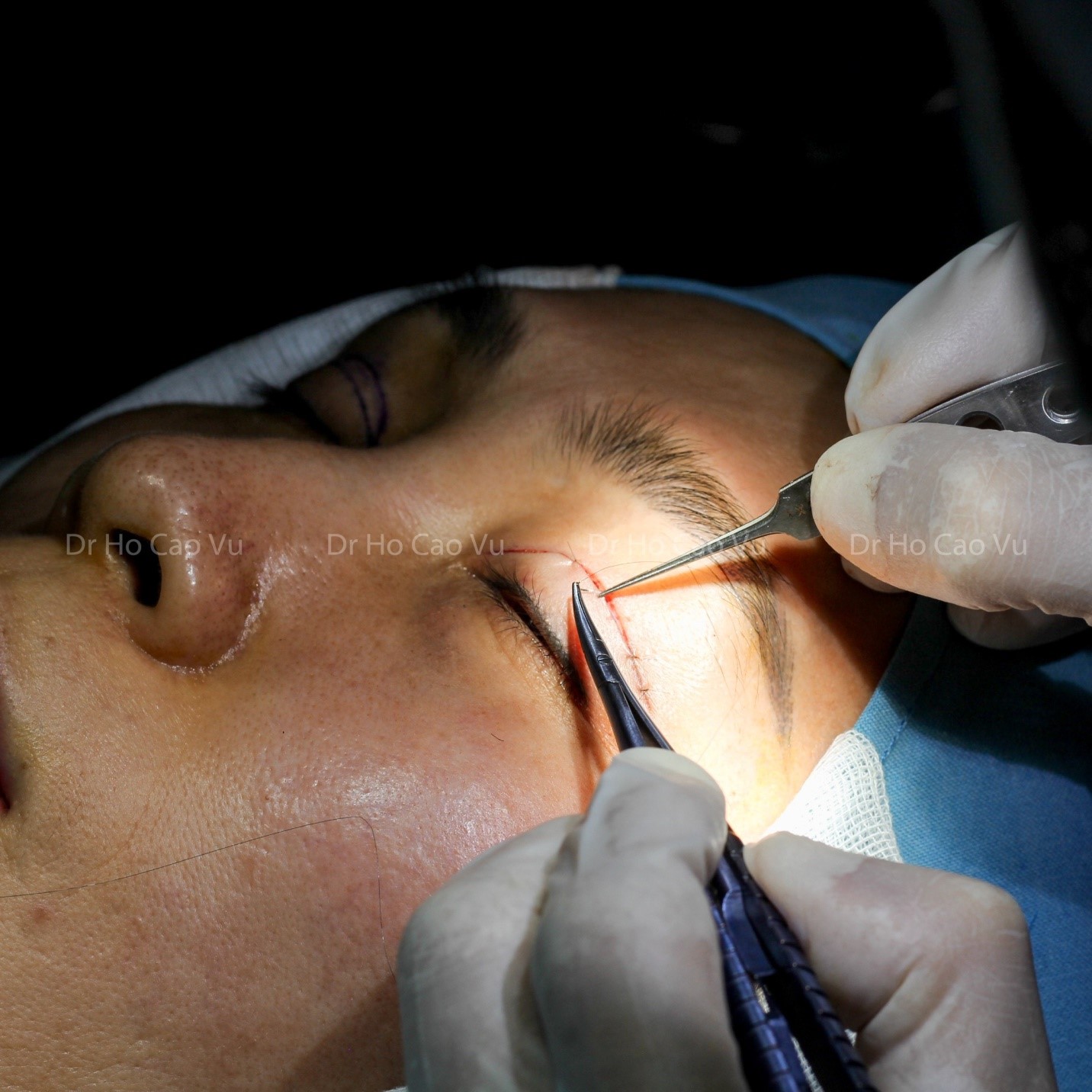 Lấy lại vẻ hoàn hảo cho đôi mắt của bạn bằng phẫu thuật cắt mí mắt. Với đội ngũ chuyên gia giỏi và nhiều kinh nghiệm, quy trình phẫu thuật sẽ được thực hiện an toàn và hiệu quả nhất. Một đôi mắt khỏe mạnh và xinh đẹp sẽ đón chào bạn từ bây giờ.