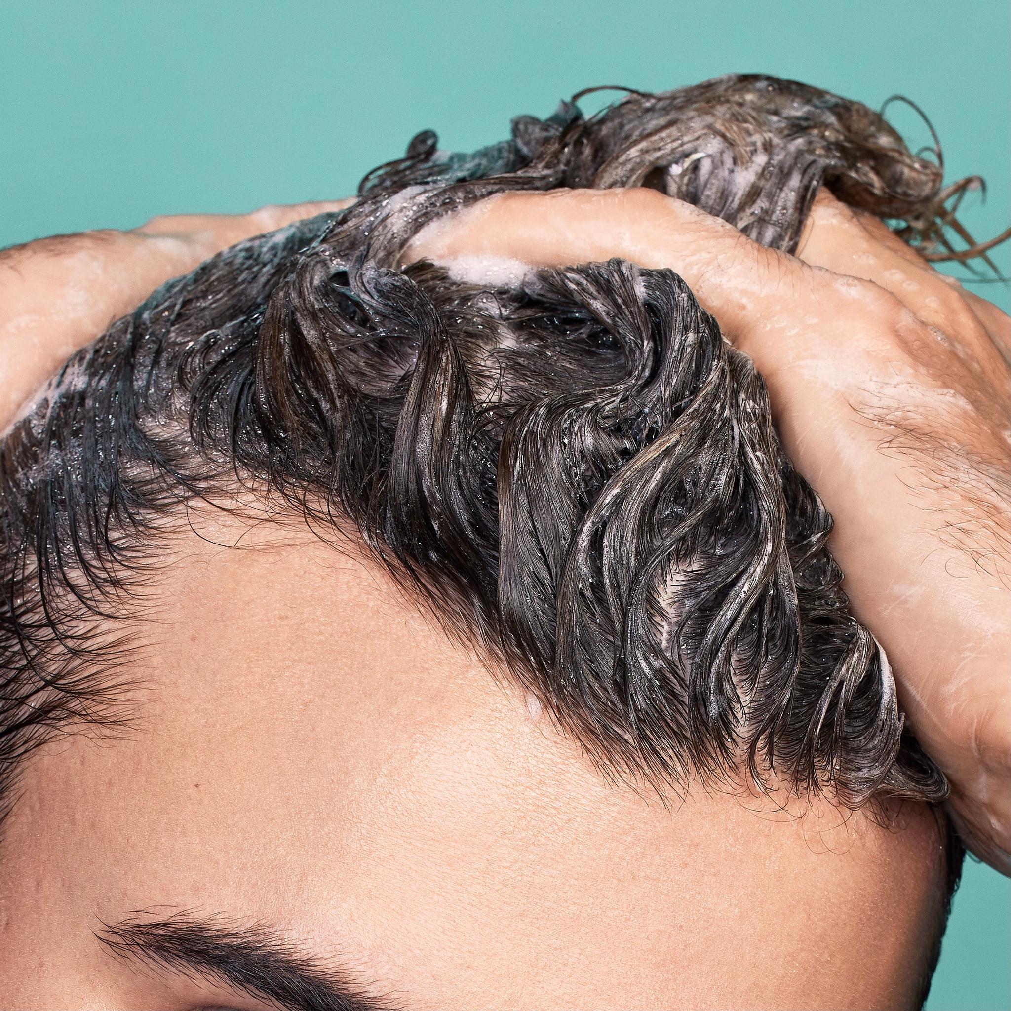 Rụng tóc  Rối loạn Da liễu  Cẩm nang MSD  Phiên bản dành cho chuyên gia