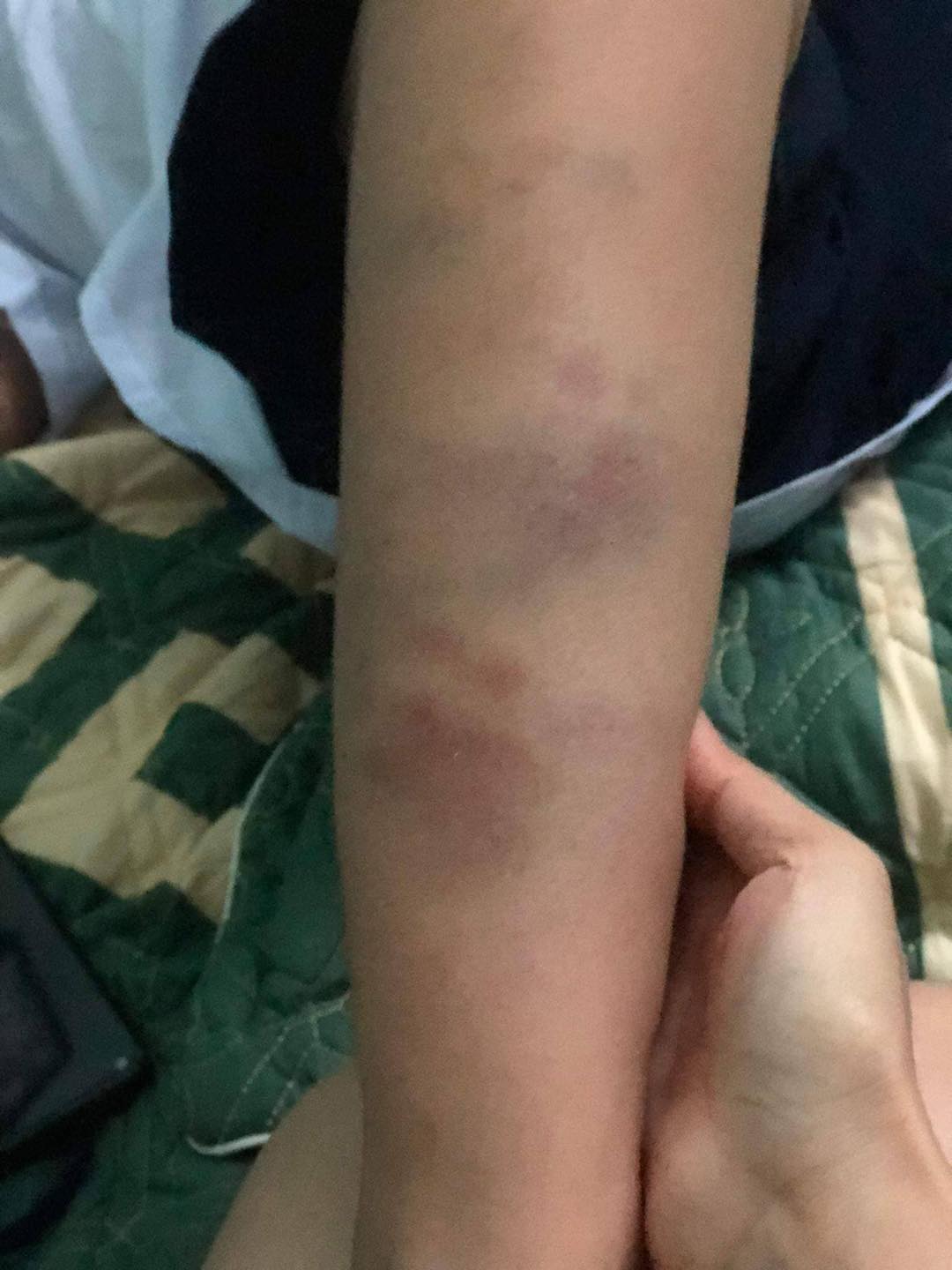 Đà Nẵng: Học sinh lớp 1 đi học về bị bầm tím tay chân do bạn đánh