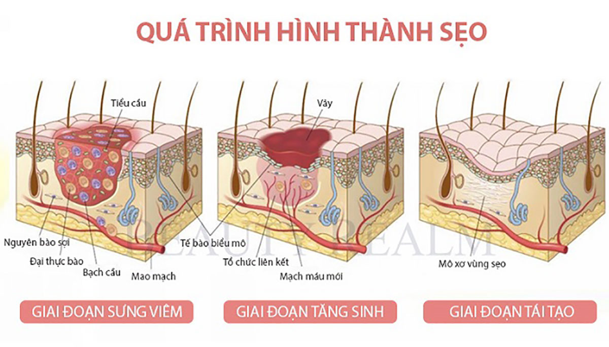 Nguyên nhân gây sẹo lồi và cách trị sẹo lồi hiệu quả hiện nay