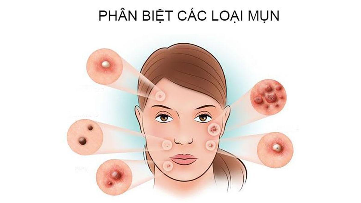 Phân biệt các loại mụn thường gặp và cách điều trị