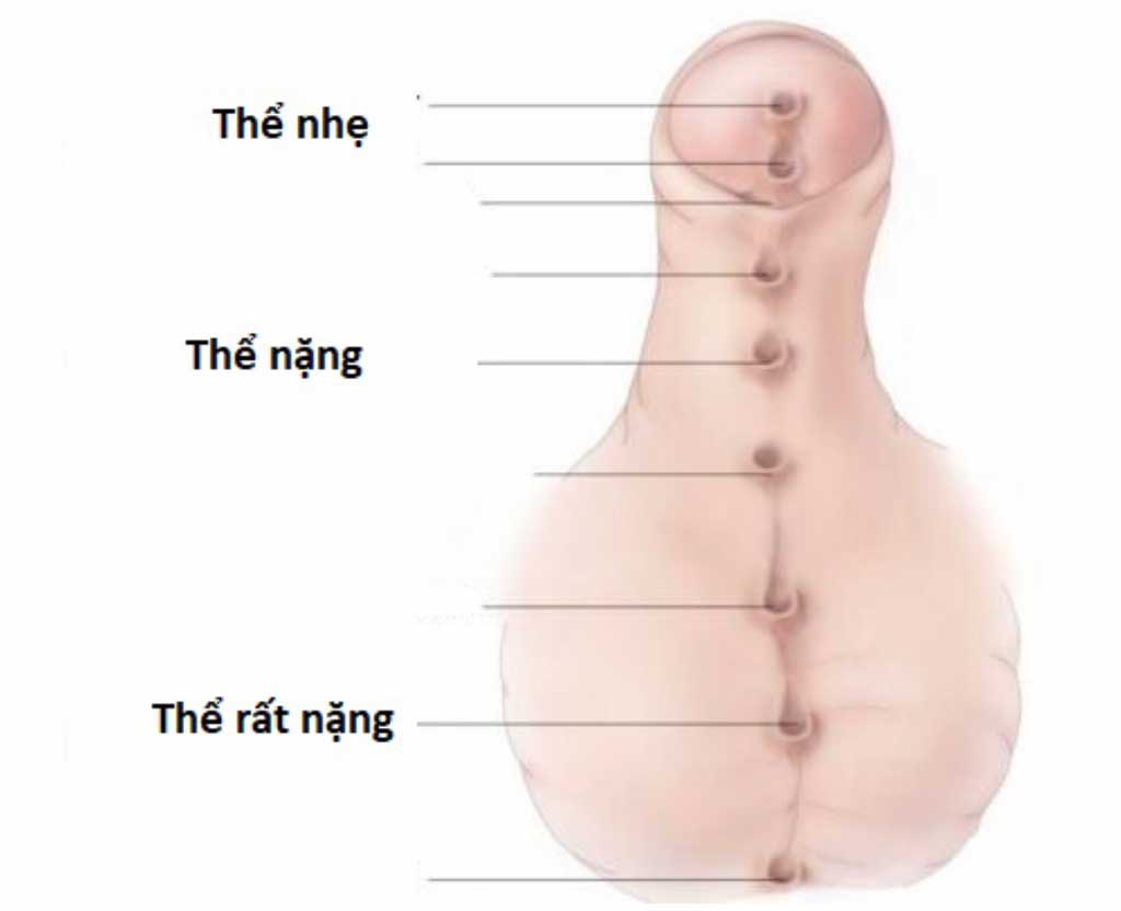 Dị tật lỗ tiểu thấp và hình ảnh kinh dị có thể thật là nỗi sợ hãi của nhiều người. Tuy nhiên, nếu bạn muốn tìm hiểu sâu hơn về dị tật này và những hình ảnh kinh dị, thì đây sẽ là cơ hội tuyệt vời. Đừng quên chuẩn bị tâm lý trước khi bắt đầu.