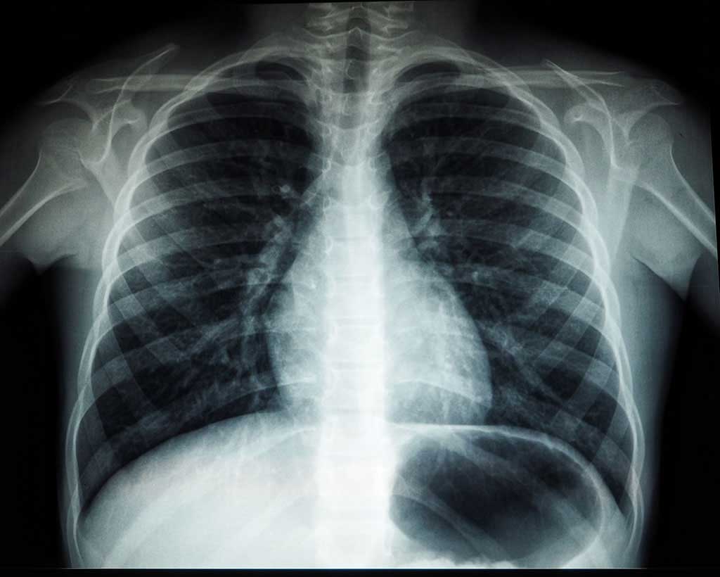 Thấy gì trong phim chụp phổi của bệnh nhân Covid-19 vào 1 năm sau?
