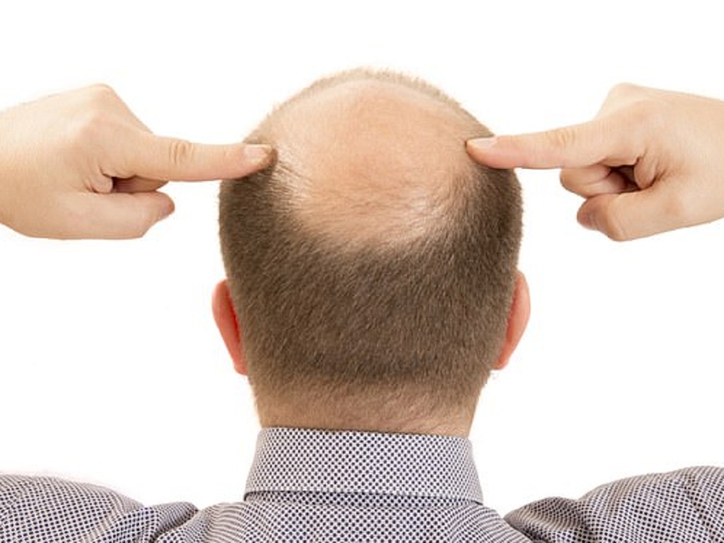 12 nguyên nhân gây rụng tóc nhiều và cách khắc phục  Rungtocvn