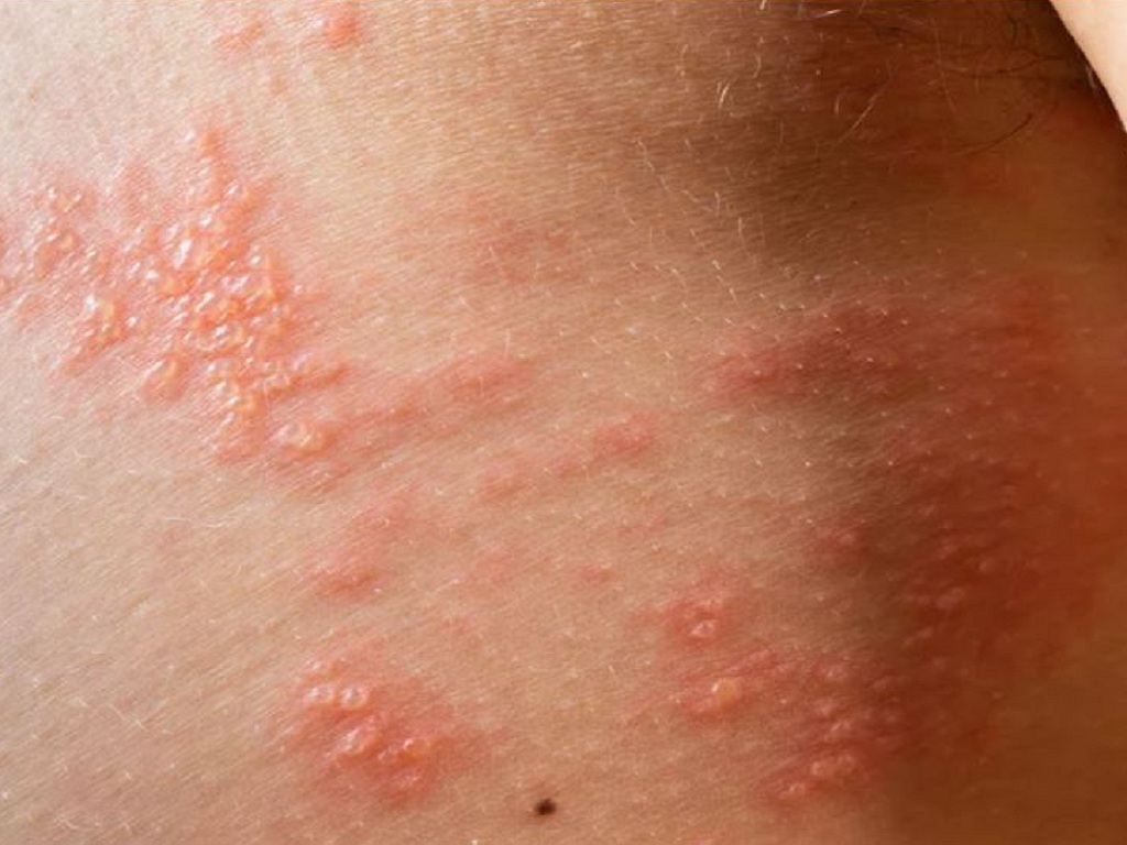 Bệnh giời leo có tái phát không?