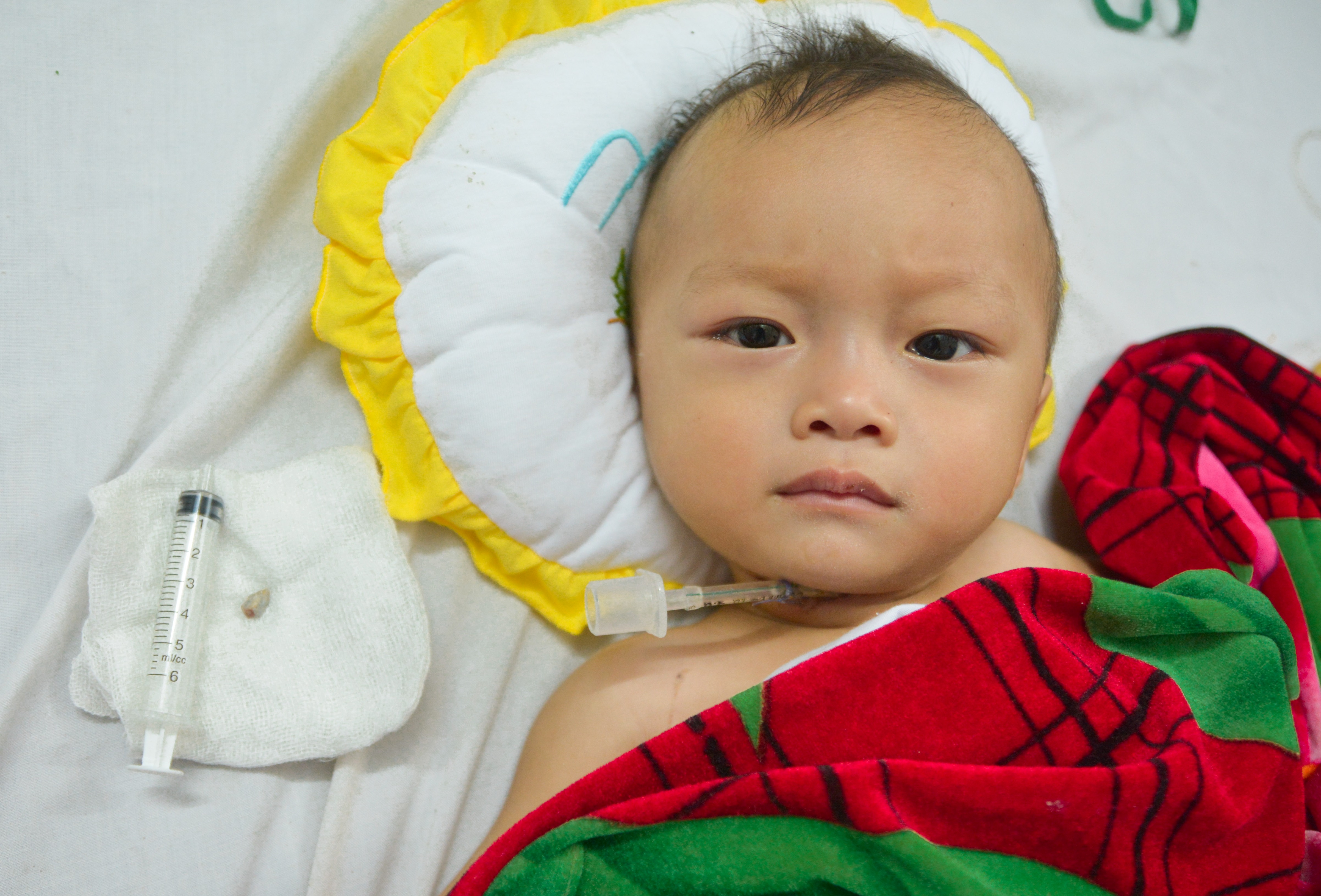 Bệnh nhi Duy đã ổn định sức khỏe sau ca phẫu thuật - Ảnh: Phạm Đức